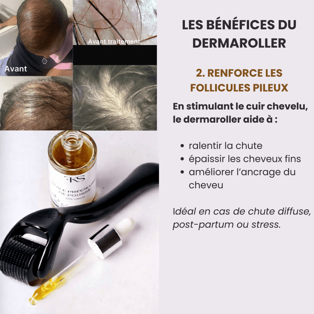 Dermaroller FKSECRETS - Accélérateur de pousse - FKsecret
