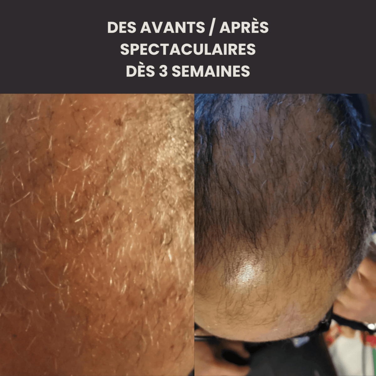 Huile Précieuse de Pousse : anti zones dégarnies, pelade et perte de volume - FKsecret